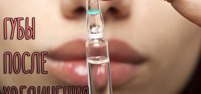 Губы после увеличения гиалуроновой кислотой – что нельзя и можно делать?