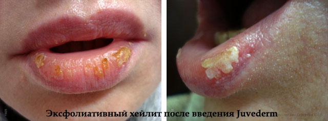 Возможные последствия увеличения губ гиалуроновой кислотой