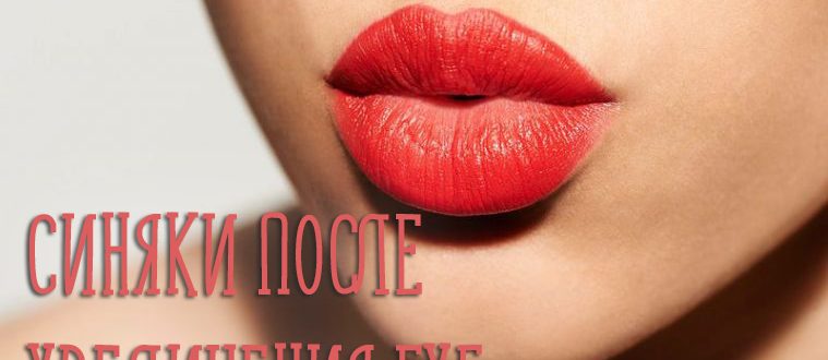 Синяки после увеличения гиалуроновой кислотой – чем лечить гематомы?