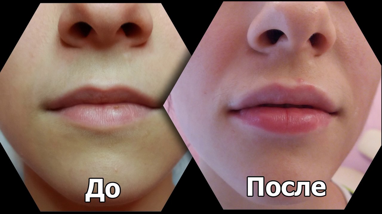 2 мл филлера в губы фото до и после