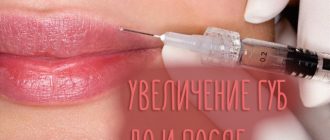 Увеличение губ – до и после с фото