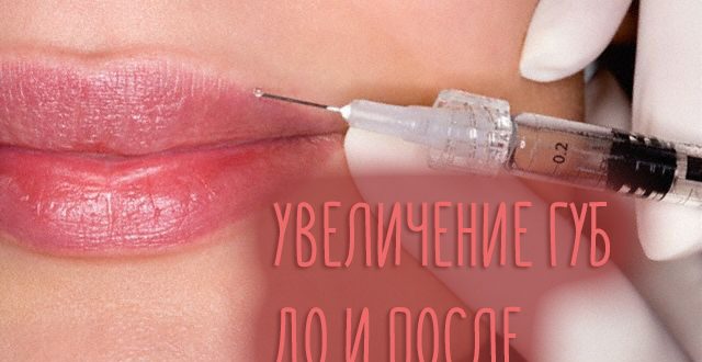 Увеличение губ – до и после с фото