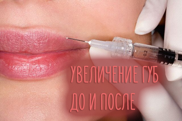 Увеличение губ – до и после с фото