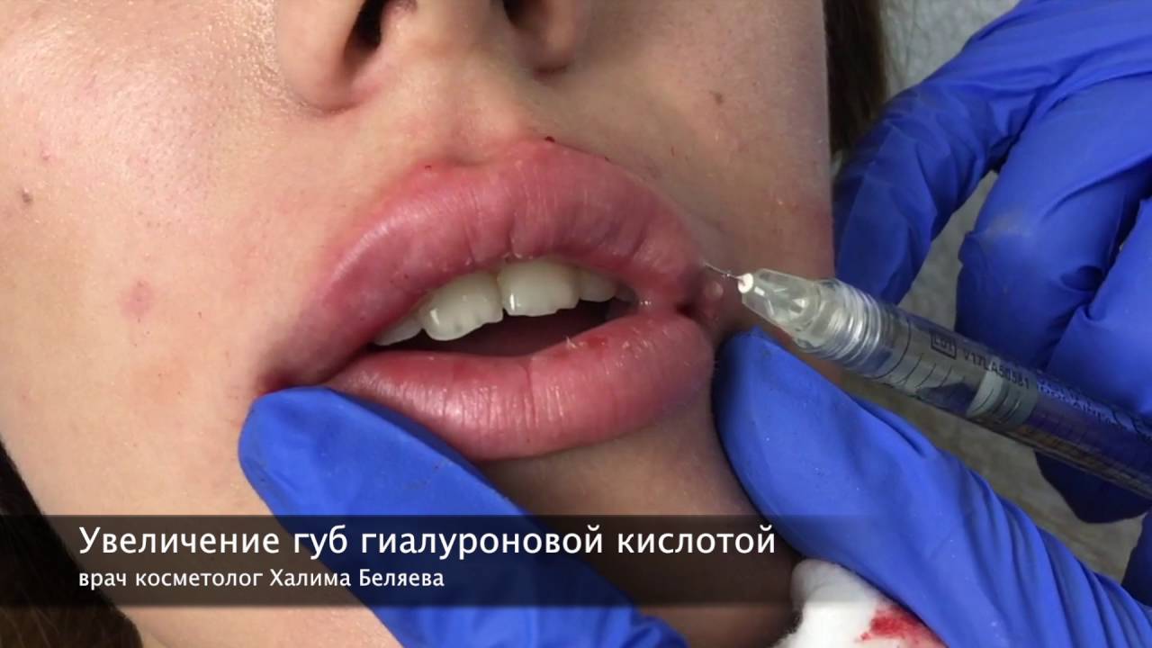 Как делают увеличение губ гиалуронкой?