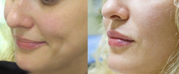 Фото до и после биоревитализации губ гиалуронкой