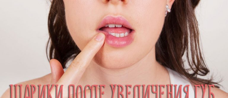 Что делать, если после увеличения губ гиалуроновой кислотой появились шарики?