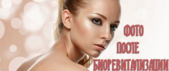 Фото до и после биоревитализации – магия в действии!