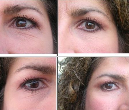 Биоревитализация глаз – фото до и после: