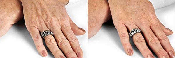 Биоревитализация рук – фото: