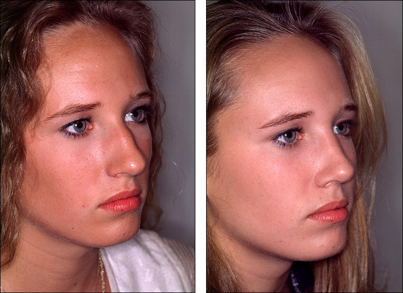 Ринопластика глаз фото до и после