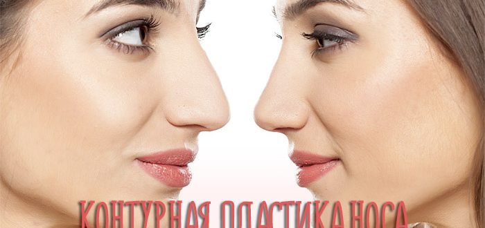Контурная пластика носа – фото до и после