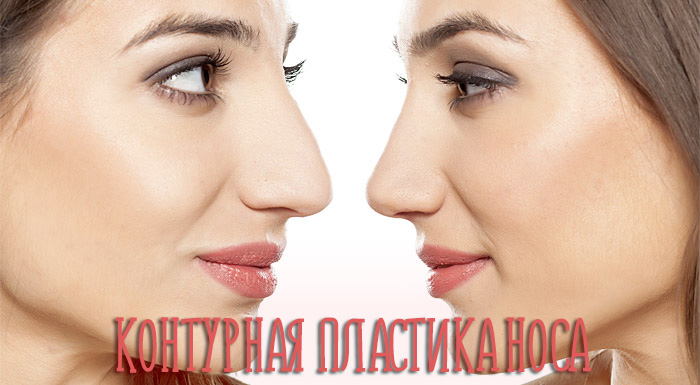 Контурная пластика носа – фото до и после