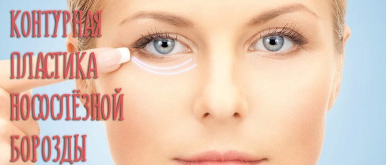 Контурная пластика носослёзной борозды