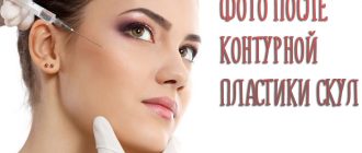 Контурная пластика скул и щёк – фото работ лучших мастеров