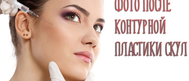 Контурная пластика скул и щёк – фото работ лучших мастеров