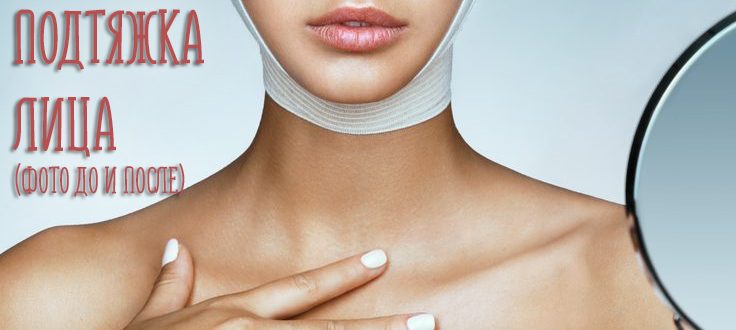 Круговая подтяжка лица. Отзывы, стоимость, фото до и после операции