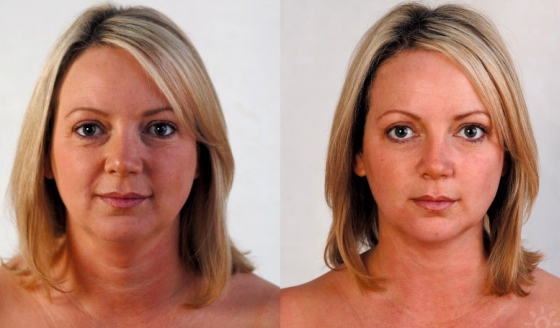 Фото до и после операций