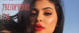 Неудачное увеличение губ гиалуроновой кислотой