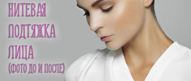 Нитевая подтяжка лица. Фото до и после операций
