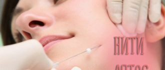 Нити Aptos для подтяжки лица. Виды, действие и отзывы