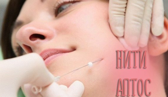 Нити Aptos для подтяжки лица. Виды, действие и отзывы