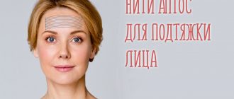Нити Aptos и хирургическая круговая подтяжка лица. Виды, действие и отзывы