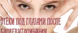 Отёки под глазами после биоревитализации – что делать и как убрать?