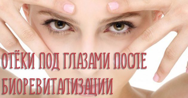 Отёки под глазами после биоревитализации – что делать и как убрать?