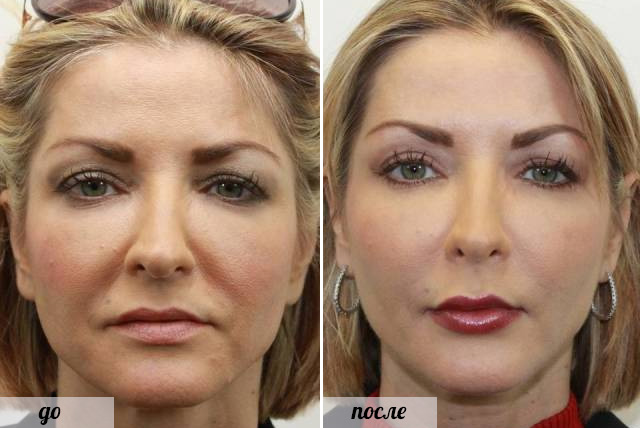 Фото до и после процедур