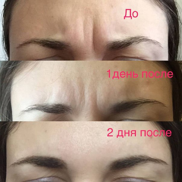 Фото до и после процедур