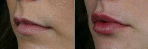 Отзывы о контурной пластике губ