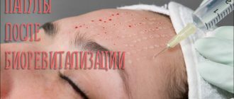 Папулы после биоревитализации – сколько дней держаться и можно ли считать их нормой?