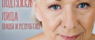 Подтяжка лица. Стоимость, виды, фото до и после операции