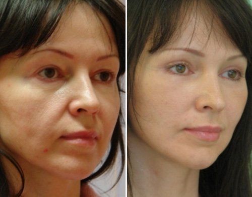 Фото до и после операций