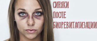 Синяки после биоревитализации – как лечить и быстро убрать проблему?