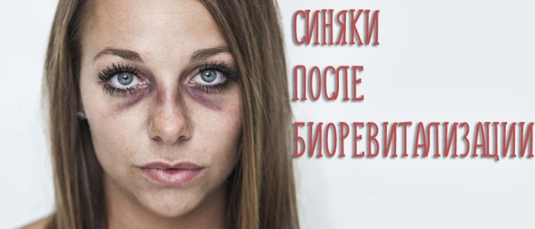 Синяки после биоревитализации – как лечить и быстро убрать проблему?
