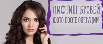 Лифтинг бровей – реальные фото до и после