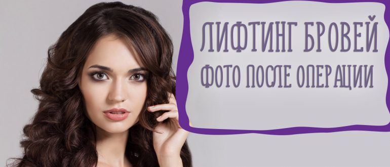 Лифтинг бровей – реальные фото до и после