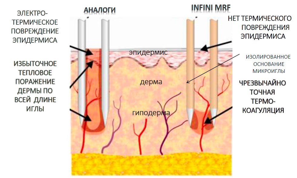 INFINI для 3D RF лифтинга