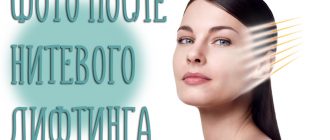 Нитевой лифтинг лица. Фото до и после проведения операций