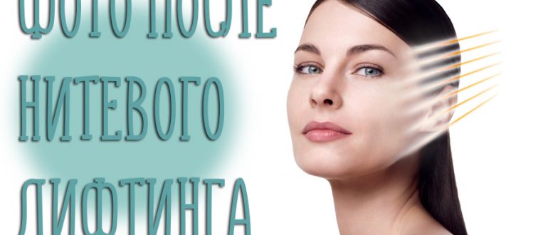 Нитевой лифтинг лица. Фото до и после проведения операций