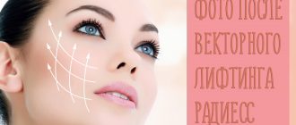 Отзывы на векторный лифтинг лица с фото до и после на препарате Радиесс