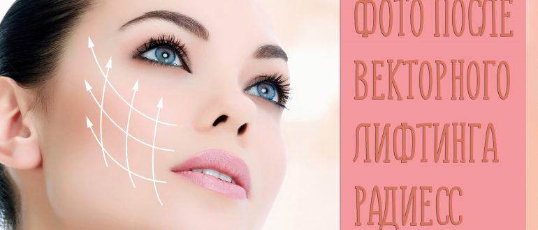 Отзывы на векторный лифтинг лица с фото до и после на препарате Радиесс
