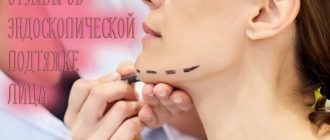 Отзывы об эндоскопической подтяжке лица