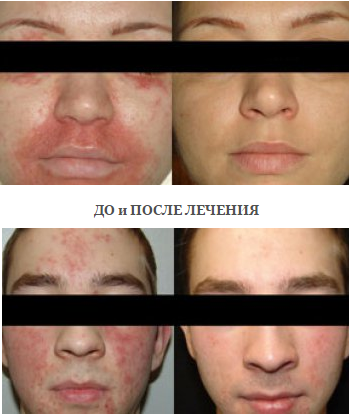 Фото до и после применения кремов от дерматита