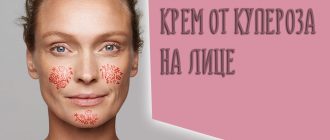 Крем от купероза на лице – можно ли найти хорошее антикуперозное средство в аптеке?