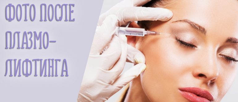Отзывы на плазма лифтинг для лица и удивительные фото до и после
