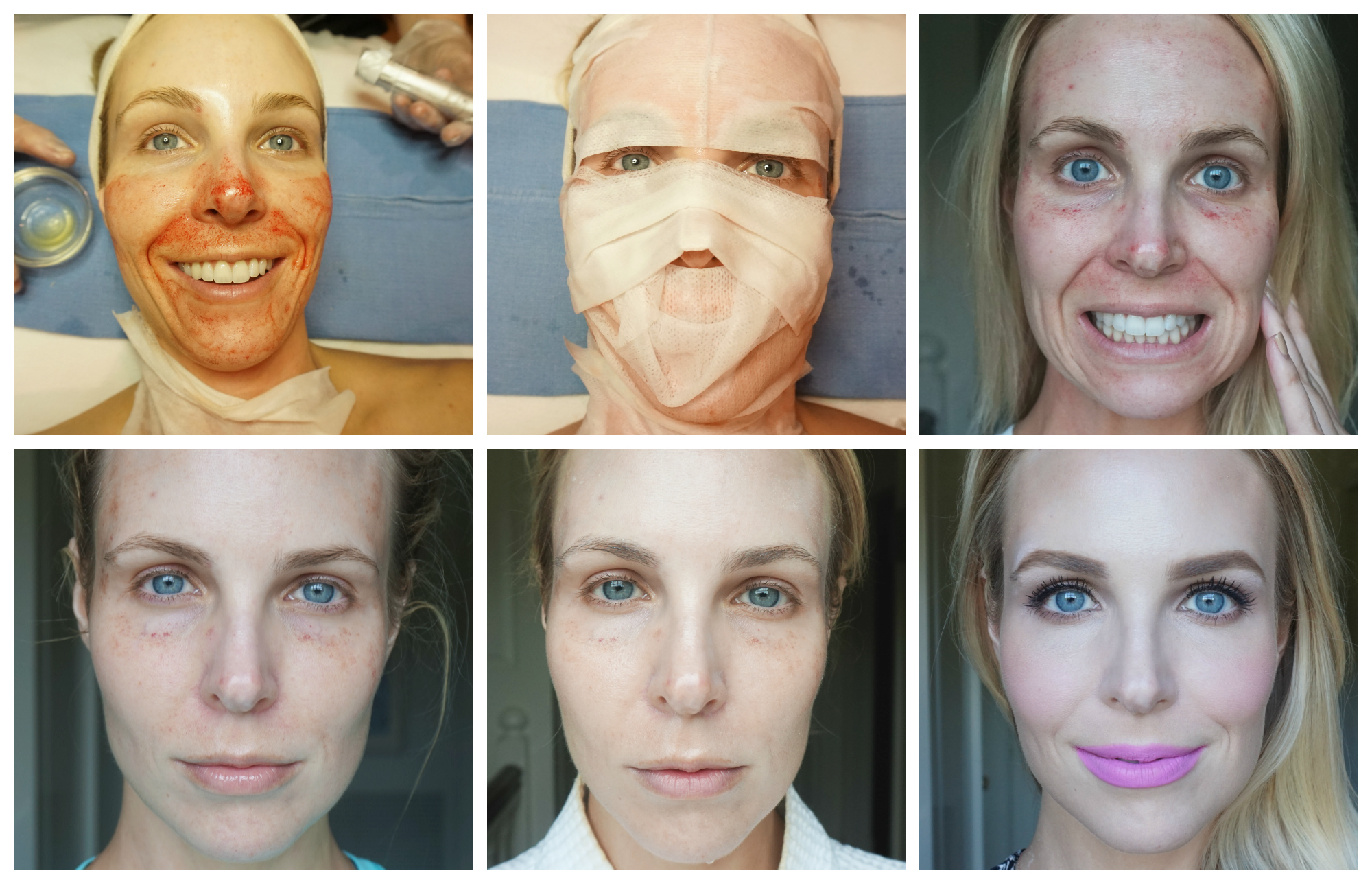 Плазменная подтяжка. Плазмолифтинг для лица до и после фото. Плазмолифтинг лица до и после.