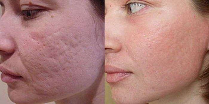 Фото до и после комбинированной чистки лица