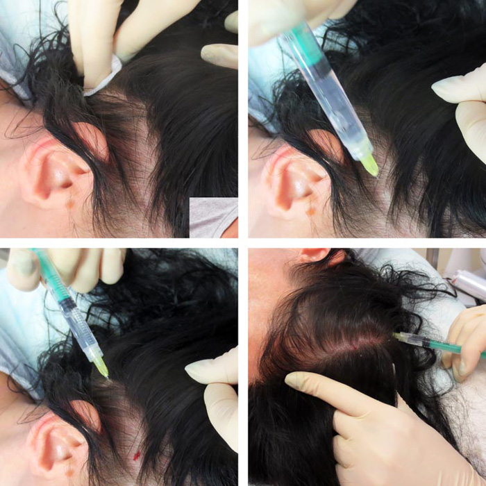Виды мезотерапии и препараты для лечения волос